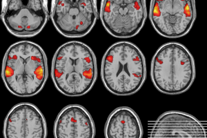 La UPV y el INCLIVA impulsan un proyecto para mejorar los sistemas de diagnóstico y tratamiento en psicosis