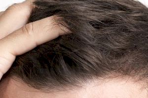 La caída del pelo por estrés