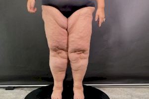 Nace el Instituto Valenciano de Lipedema para dar visibilidad a esta enfermedad y avanzar en su diagnóstico y tratamiento