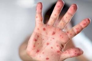 La Comunitat Valenciana frega el centenar de contagiats per la pigota del mico