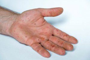 Sanitat confirma 24 nous positius de pigota del mico en la Comunitat Valenciana