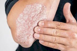 Trece hospitales de la Comunitat Valenciana aplican el control telemático de la psoriasis