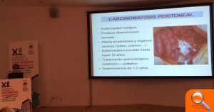 Enfermería Quirúrgica del Hospital de Elche, clave en el tratamiento de pacientes con carcinomatosis peritoneal